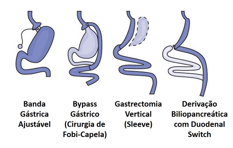 Emagrecer sem cirurgia, tipos de cirurgia bariátrica